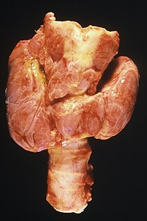 Goitre swelling of the thyroid gland