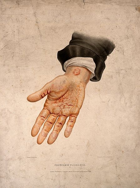 File:A hand with a skin disease on the palm and wrist. Coloured l Wellcome V0009863.jpg