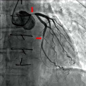 Cine-coronary angiography was developed at Cleveland Clinic by F. Mason Sones, MD, in the late 1950s. Angiography coronary stenosis 01.jpg