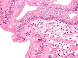 Histologisch beeld van de slokdarm van Barrett