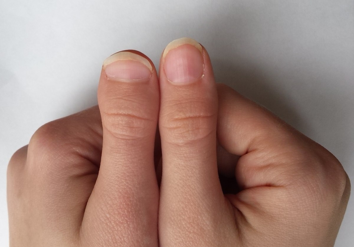 Brachydactyly Types - Causes & Outlook