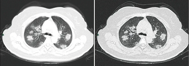 Hurtigt fremadskridende udviklingstrin ('rapid progression stage'[note 6])