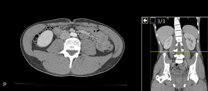 CT of a normal abdomen and pelvis, axial plane 149.png