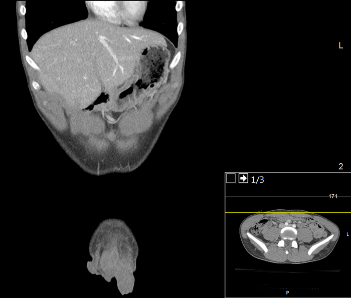 CT of a normal abdomen and pelvis, coronal plane 33.png