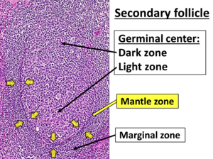 Follicular Lymphoma