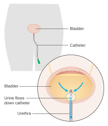 Image of a urinary catheter, a common cause of healthcare associated infections. Diagram showing a urinary catheter in a woman CRUK 085.svg