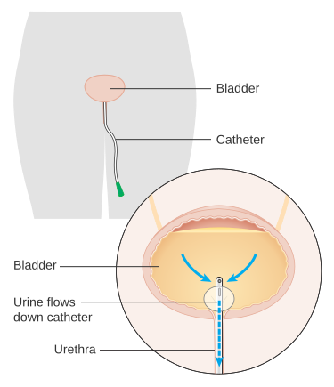 File:Diagram showing a urinary catheter in a woman CRUK 085.svg