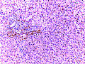 Hemochromatosis Liver 20x.jpg