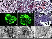 Histopathology of collapsing glomerulopathy. (A,B) Periodic Acid Schiff (PAS) and Jones Methenamine Silver (JMS) (40x), respectively show intense podocyte hyperplasia and glomerular tuft collapse. (C) JMS (20x) exhibits microcytic transformation of distal convoluted tubules with accumulations of hyaline material inside of those. (D,E) Fluorescence microscopy (40x) shows, respectively, IgM and C3 trapping in areas of collapse/sclerosis. (F) Semi-fine stained in Toluidine Blue (63x) with collapse of the entire glomerular tuft and hyperplasia of podocytes and dilated Bowman's space. (G,H) Transmission electron microscopy contrasted with Osmium Tetroxide, Lead Citrate and Uranyl in block shows capillary loop collapse with hyalinosis in addition to diffuse fusion and flattening of the pedicels associated with microvillous transformation. (I) Electron microscopy tubes contrasted with osmium tetroxide, lead citrate, and uranyl in block with detail of disorganization of the cytoskeleton in the podocyte cytoplasm, with extensive effacement of the pedicels. Histopathology of collapsing glomerulopathy.jpg