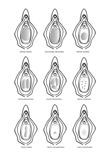 Various Types Of Hymen The Shaded Areas Represent The Vaginal Opening