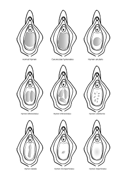 Hymen: Utseende och utveckling, Hymen och det första samlaget, Den traditionella uppfattningen av mödomshinnan