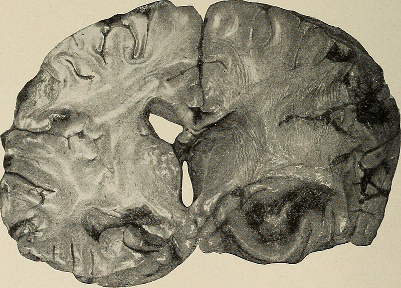 File:Nervous and mental diseases (1908) (14591345130).jpg