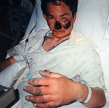 Mountaineer Nigel Vardy in hospital after developing frostbite when benighted on Denali in 1999. His nose, fingers and toes were subsequently amputated. Nigel Vardy Frostbite.jpg