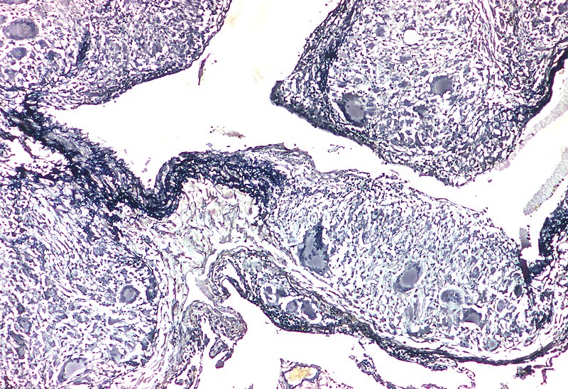 File:Sarcoidosis - Granulomatous phlebitis - Elastic tissue stain (6128092569).jpg