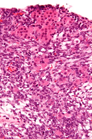 <span class="mw-page-title-main">Sertoli–Leydig cell tumour</span> Medical condition