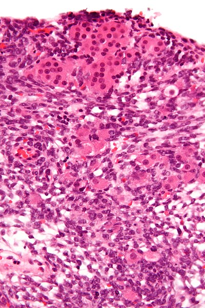 File:Sertoli-Leydig cell tumour - very high mag.jpg