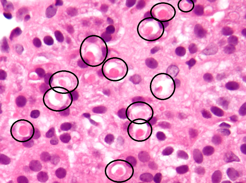 File:Spironolactone bodies.png