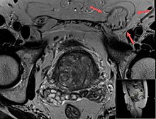 T2 weighted MRI of the same case (done for another purpose), also demonstrating fat content. T2 weighted MRI of inguinal hernia (annotated).jpg