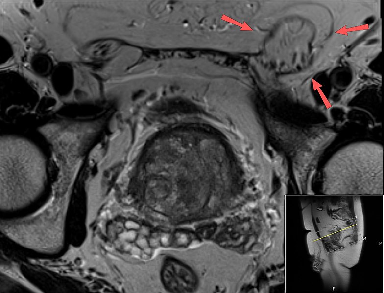 File:T2 weighted MRI of inguinal hernia (annotated).jpg