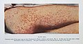 Toxaemic rash of smallpox Wellcome L0032961.jpg