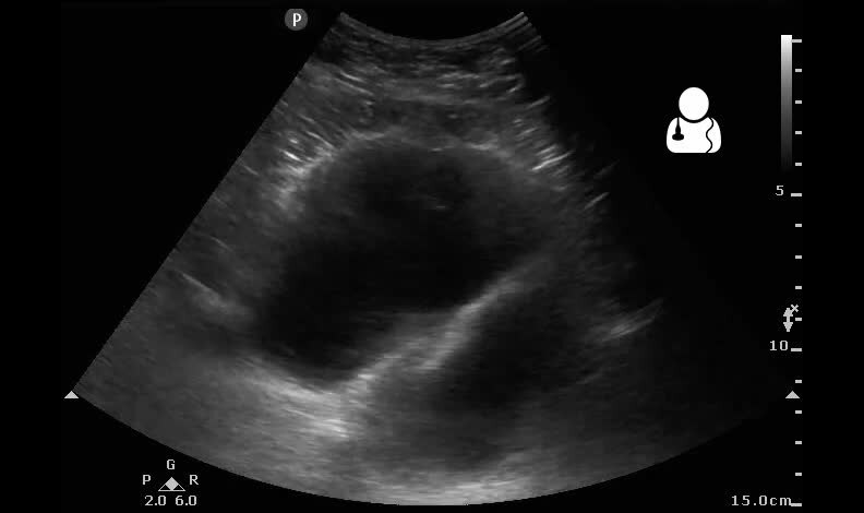 ملف:UOTW 56 - Ultrasound of the Week 1.webm