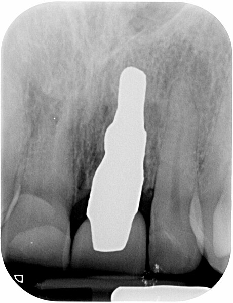 File:X-ray of root analogue dental implant left central incisor.jpg