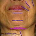 Fig. 12. Déglutition salivaire : commissures labiales, plis cutanés, plongeon caudal de la langue (« double menton ») et platysma gauche.