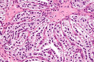 <span class="mw-page-title-main">Clear cell papillary renal cell carcinoma</span> Medical condition