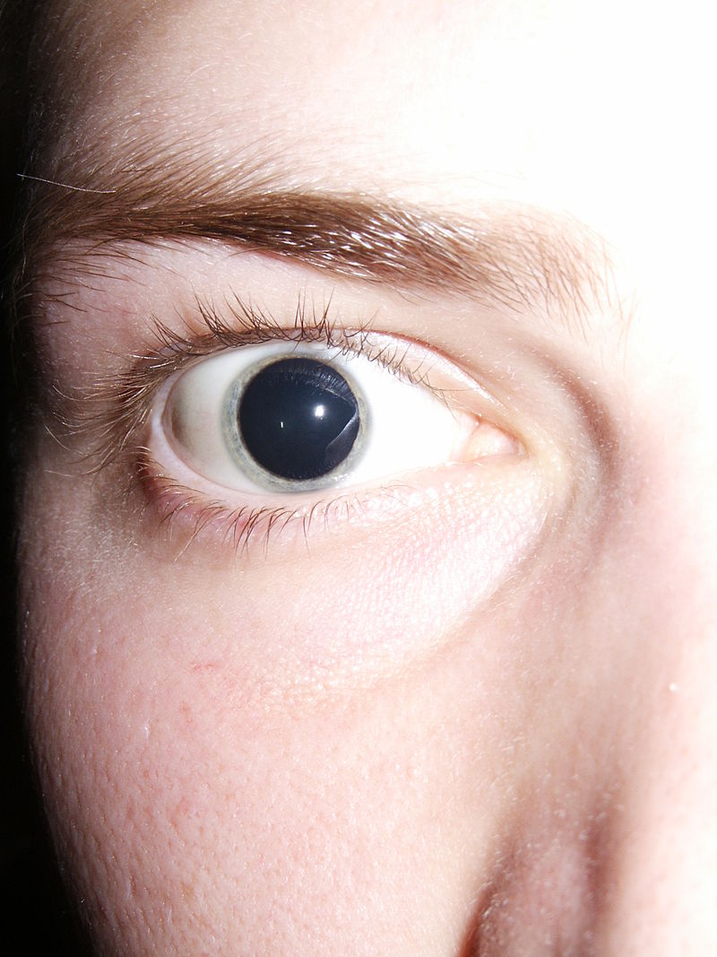 https://upload.wikimedia.org/wikipedia/commons/thumb/8/8c/Dilated_pupils_2006.jpg/800px-Dilated_pupils_2006.jpg