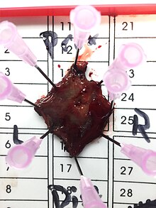 Gross pathology of a tubulovillous adenoma resected by minimally invasive colorectal surgery. Gross pathology of minimally invasive colorectal surgery of tubulovillous adenoma.jpg