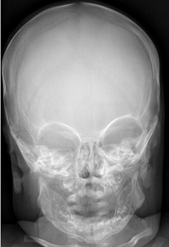 Anteroposterior radiograph of the skull showed massive sclerosis of the skull bone associated with significant cortical hyperostosis and enlargement of the mandible secondary to cortical new bone formation. Infantile cortical hyperostosis.jpg
