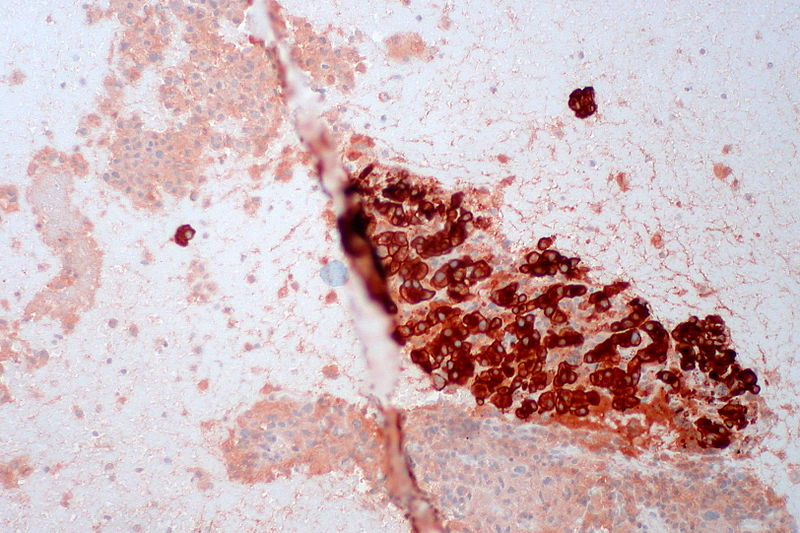 File:Malignant Melanoma, Liver FNA, Clot Section, CAM5.2 (8191269274).jpg