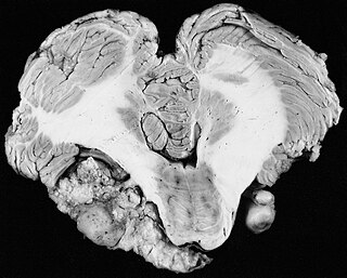 <span class="mw-page-title-main">Vestibular schwannoma</span> Benign tumor of the vestibulocochlear cranial nerve