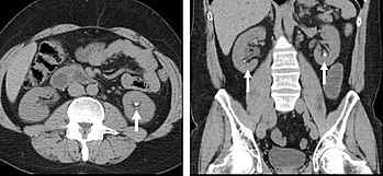 FIGURE 1. Non-contrast CT demonstrating multiple bilateral renal calculi (arrows), which can be obscured on contrast-enhanced images, particularly delayed images when there is excreted contrast in the renal collecting system; axial left, coronal reformat on right. Non-contrast CT of multiple bilateral renal calculi.jpg