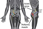 Thumbnail for Piriformis syndrome