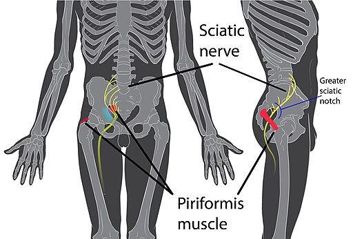 Piriformis syndrome can cause sciatica