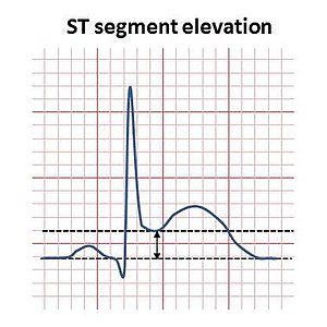 St Elevation