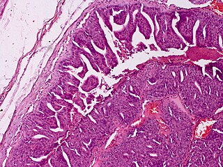 <span class="mw-page-title-main">Aggressive digital papillary adenocarcinoma</span> Medical condition