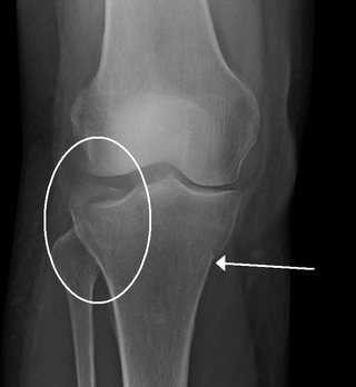 <span class="mw-page-title-main">Crus fracture</span>