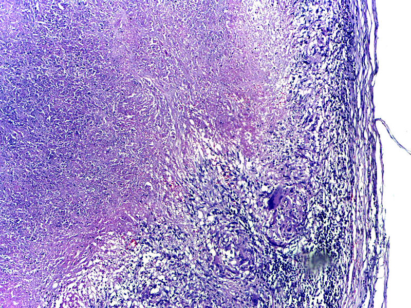 File:Tuberculous epididymitis Low Power.jpg