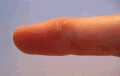 Две вирусни брадавици на средния пръст, лекувани със смес от киселини (като салицилова киселина).