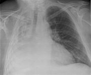 Atelectasia completa del pulmón derecho