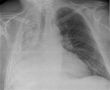 Chest x-ray demonstrating severe atelectasis or collapse of the right lung and mediastinal shift towards the right. Atelectasia1.jpg