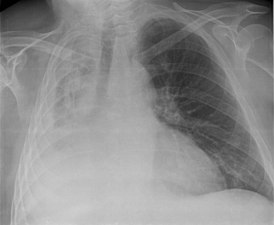 Atelectasia total del pulmón derecho (vista frontal)