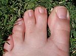 Thumbnail for Webbed toes