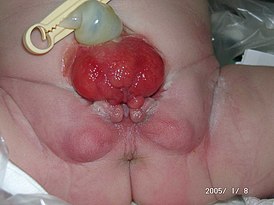 Classical bladder exstrophy.jpg
