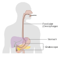 Diagram showing an endoscopic retrograde cholangio pancreatography (ERCP) CRUK 097.svg