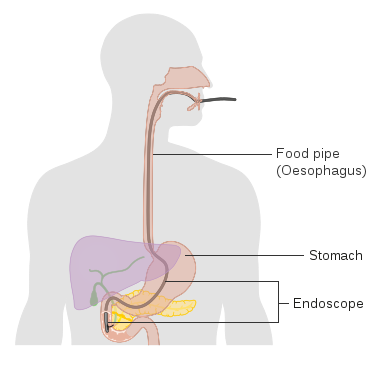 File:Diagram showing an endoscopic retrograde cholangio pancreatography (ERCP) CRUK 097.svg
