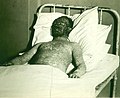 Hemorrhagic smallpox 2.jpg