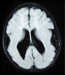 Lissencephaly:Brain MRI, T1 weighted, transverse plane, that shows lyssencephaly, manifested as scarce and wide circumvolutions, mostly in the occipital, parietal and temporal lobes. As aggregated findings, there is ventriculomegaly, no true Sylvian fissure, too thick gray matter and ectopic gray matter in the white matter. Lissencephaly.png